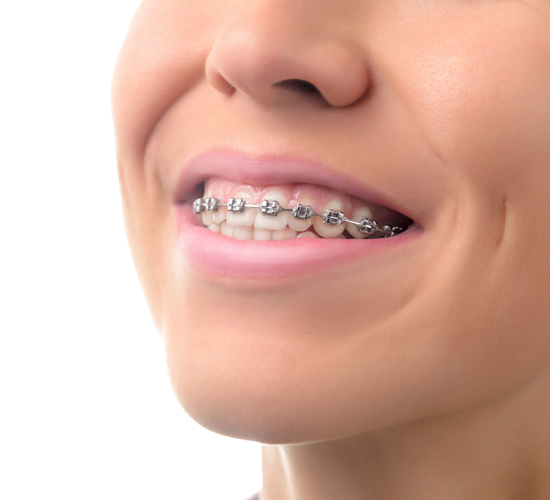 Smiling Braces