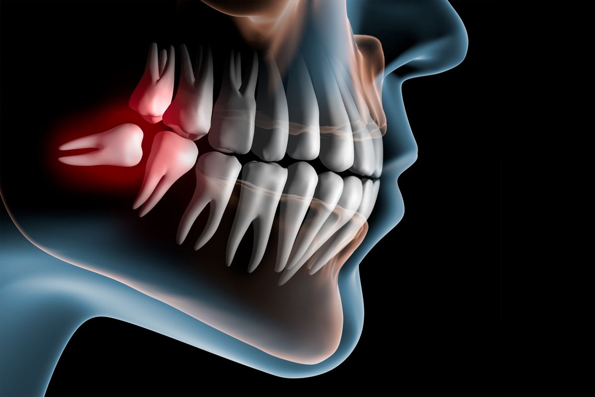 Wisdom Tooth