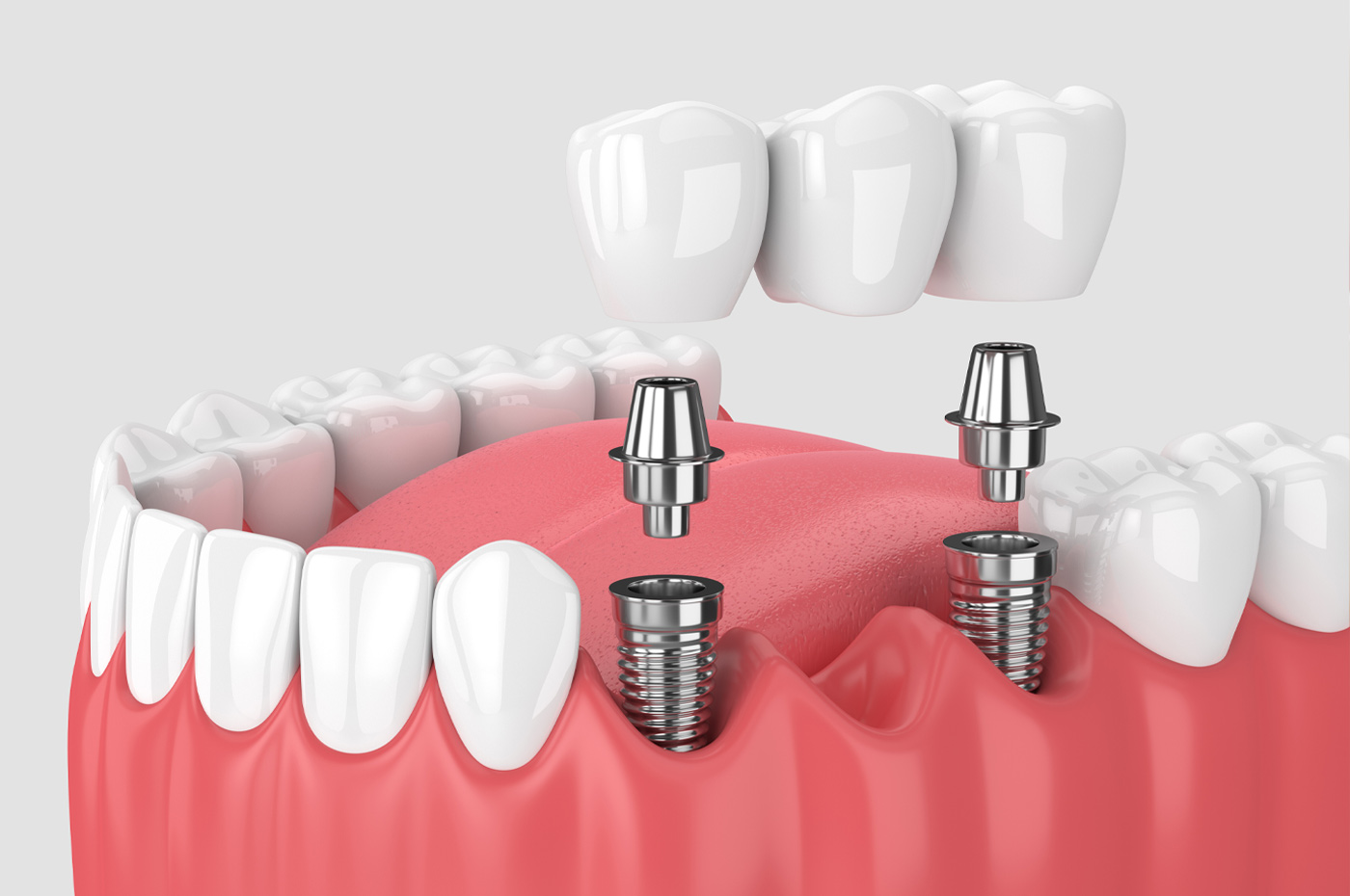 A Dental Bridge