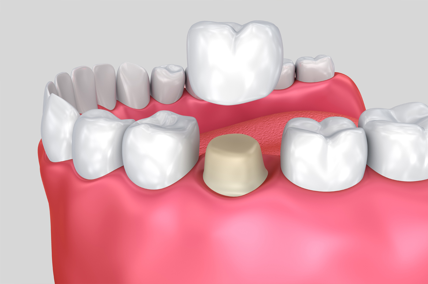 Crowned Tooth