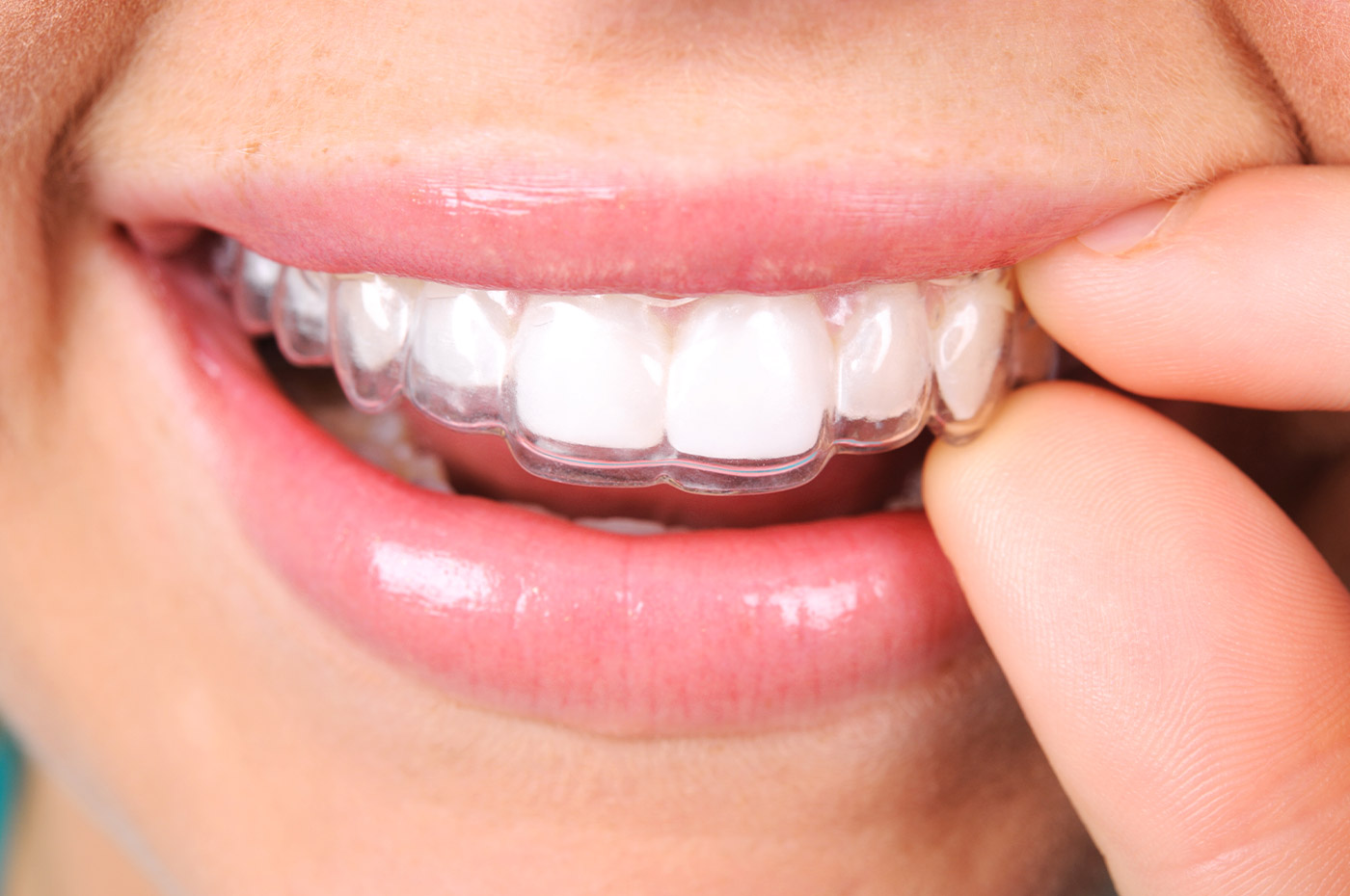 Invisalign