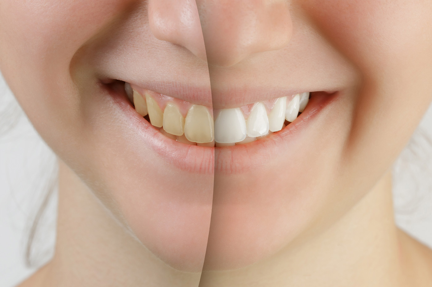 Teeth Whitening