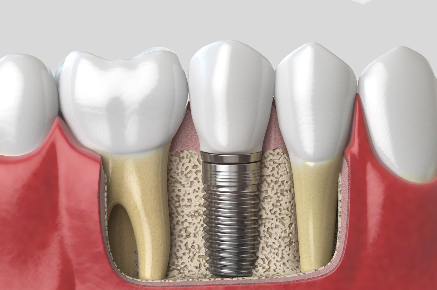 Tooth With Implant