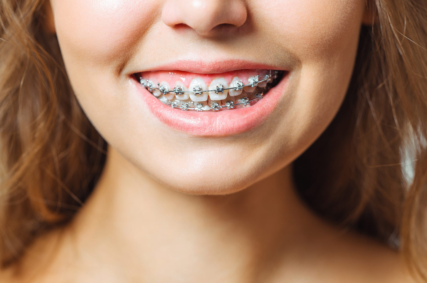Traditional Braces