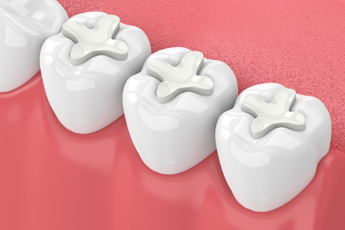 White Fillings