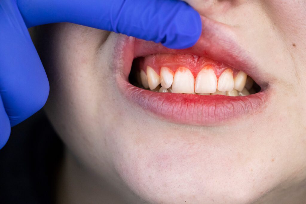 Gum Disease